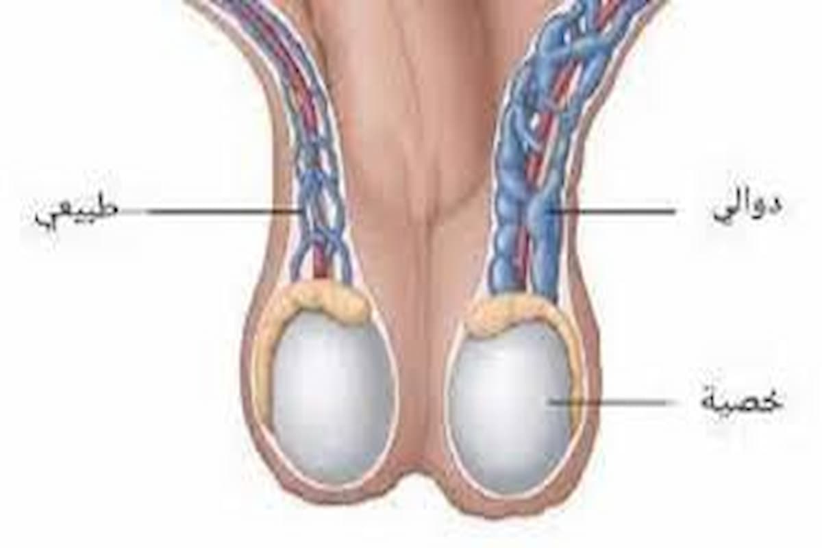 علاج دوالي الخصية طبيعيًا